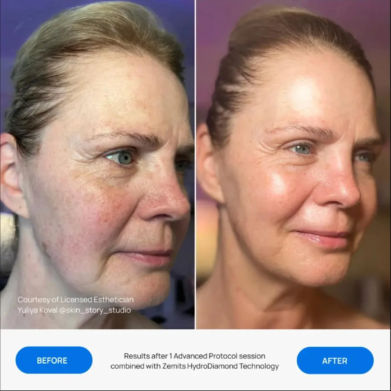 Before and after case courtesy of licensed esthetician Yuliya Koval showing results after one Advanced Protocol session combined with Zemits HydroDiamond Technology; individual results vary