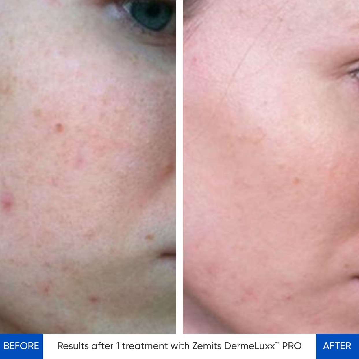 HydroDiamond platform before and after result case four