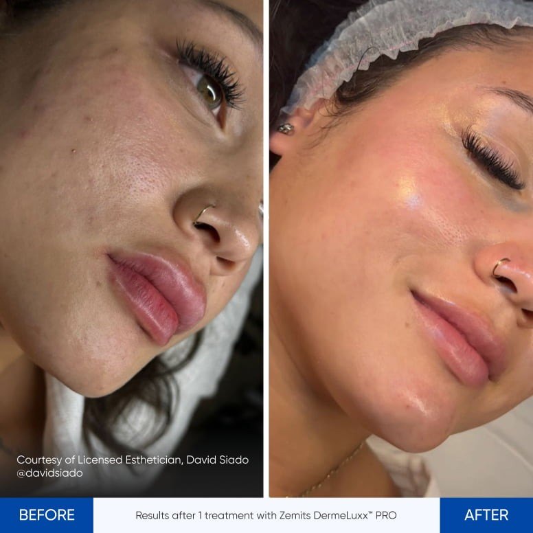 HydroDiamond before and after results from Zemits platform materials