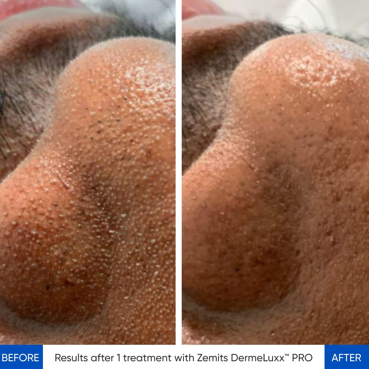 HydroDiamond platform before and after result case two