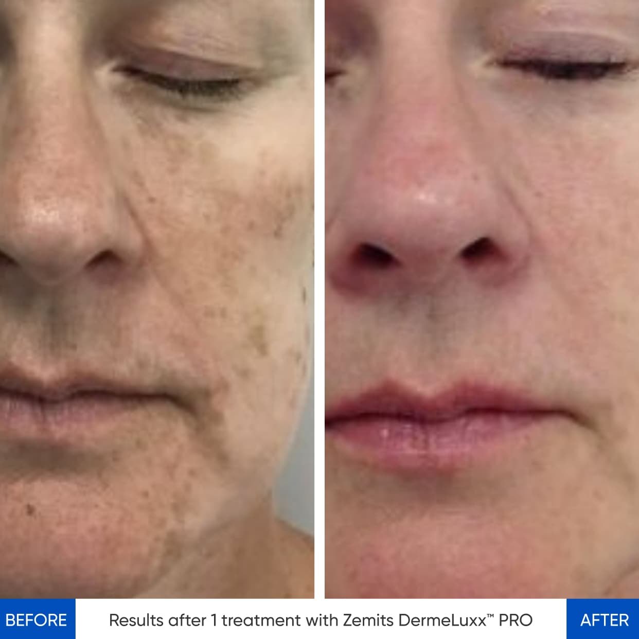 HydroDiamond platform before and after result case three