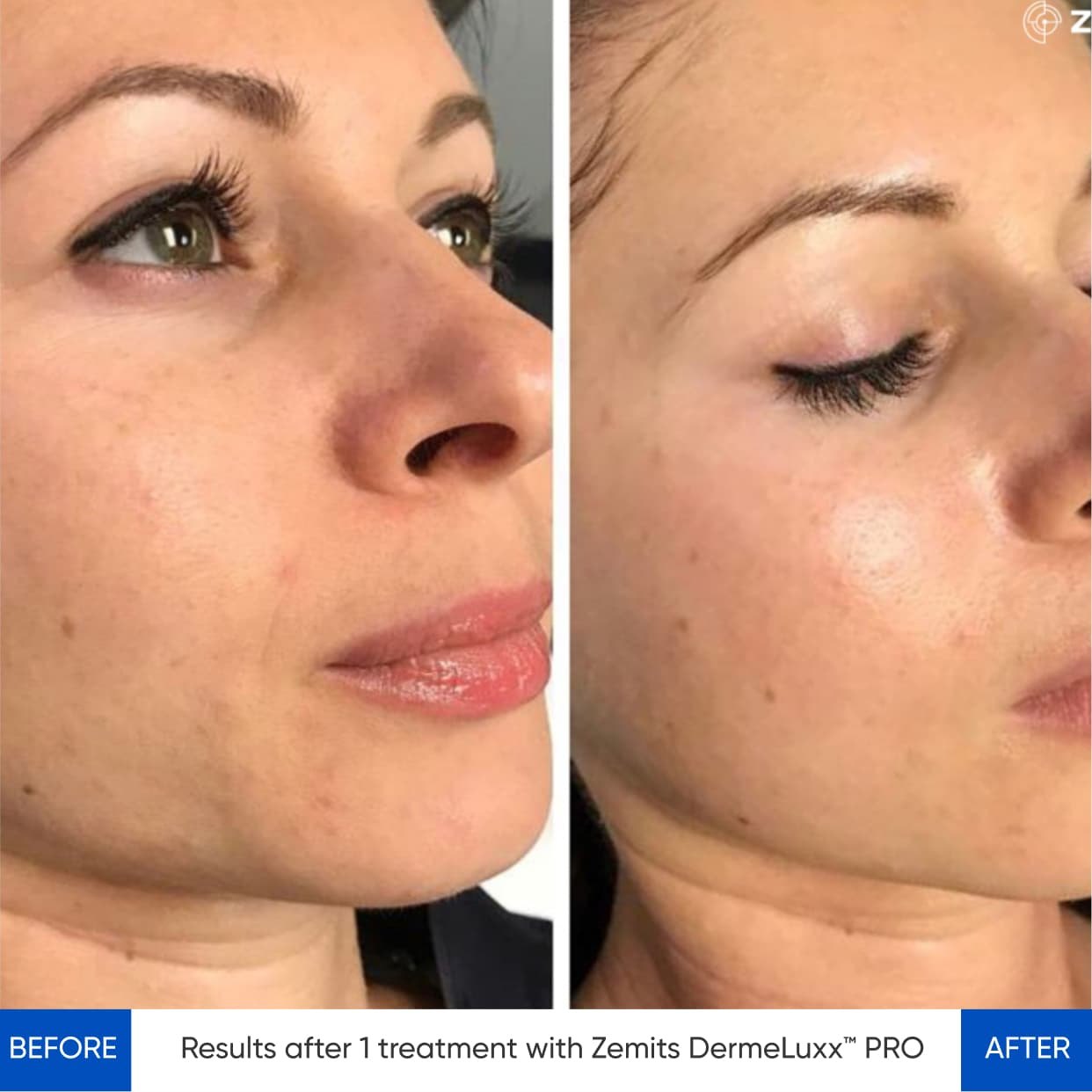HydroDiamond before and after result case showing smoother-looking skin after one DermeLuxx Pro treatment
