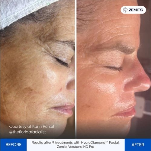 HydroDiamond facial before and after case showing improved-looking tone and texture after a treatment series